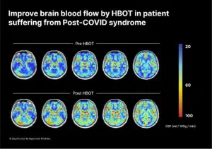 Brain Scan showing improved blood flow in post covid patients HBOT study